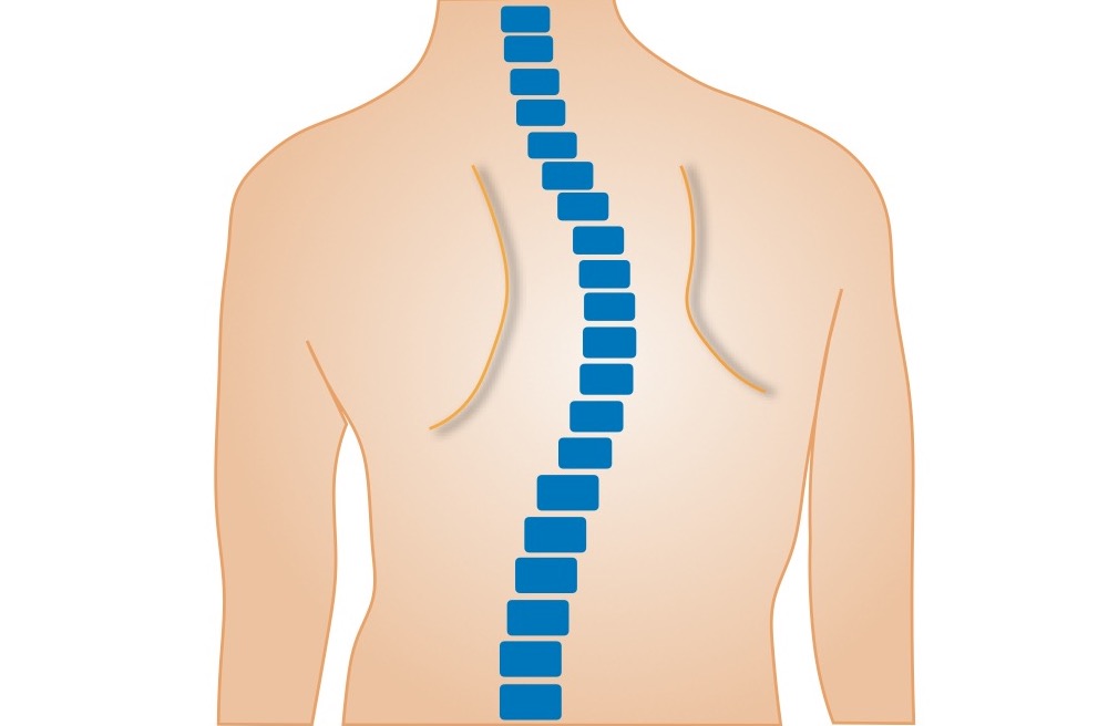 脊柱側弯症 そくわんしょう とは 背骨の歪みで起こる様々な症状