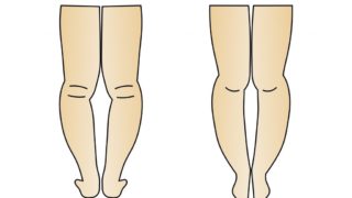 O脚の種類 その原因と改善法について 大阪本町のカイロプラクティック骨盤矯正と猫背矯正 Uenishi整体院