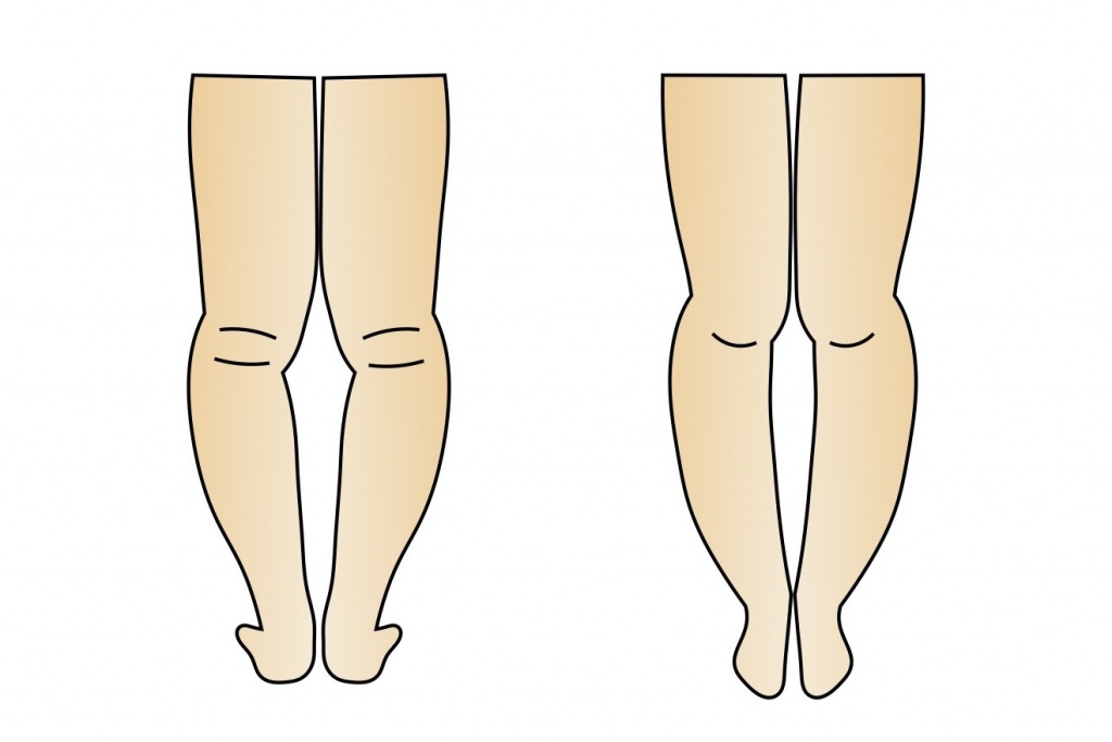 膝下o脚はなぜ起こる 膝下が開いて脚が太くなる原因と治し方