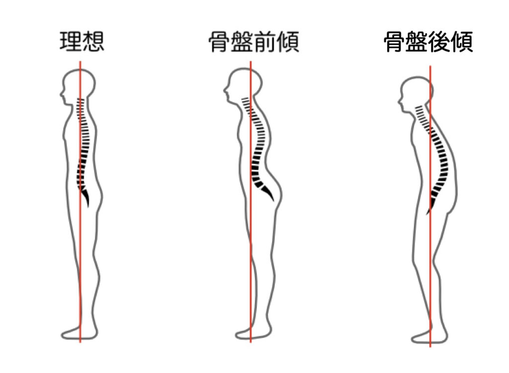 猫背反り腰の比較図