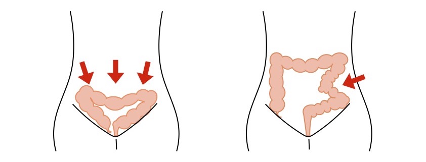 落下腸とねじれ腸