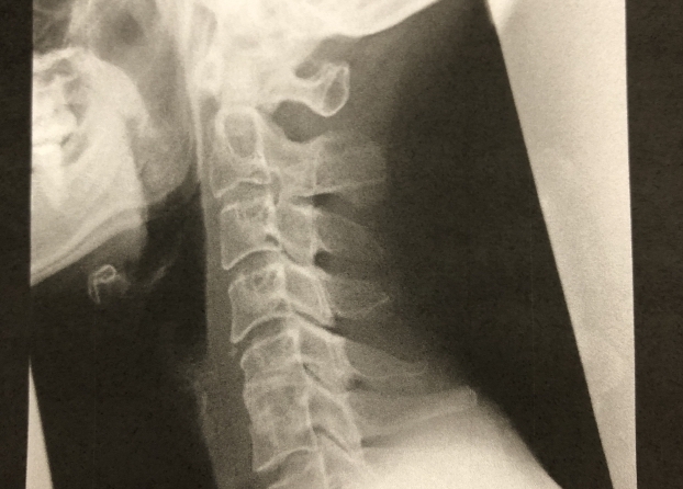 頚椎のレントゲン