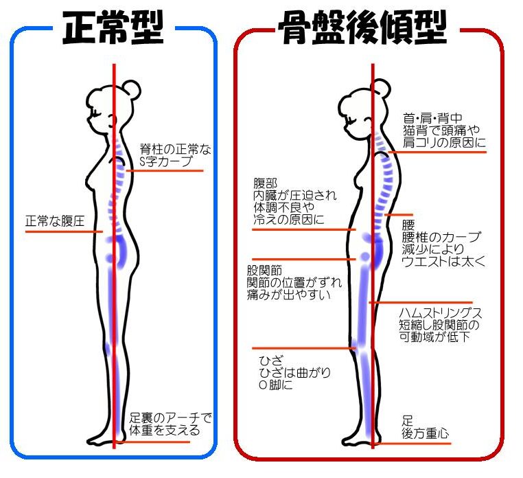 骨盤の傾きによる比較