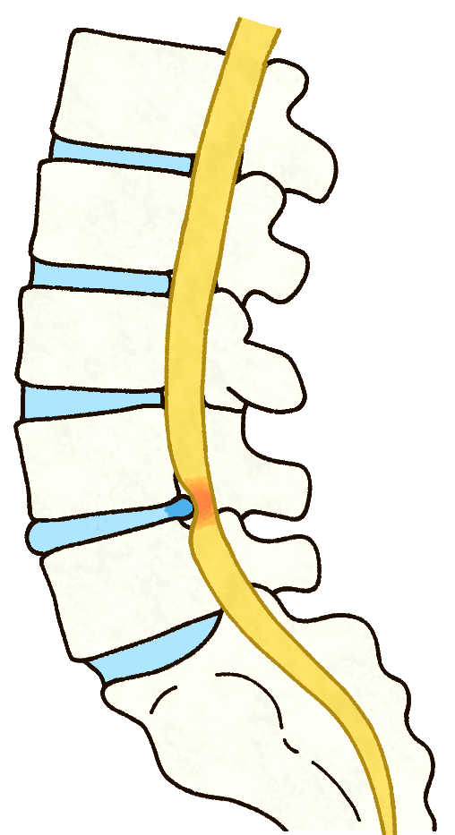 椎間板ヘルニア