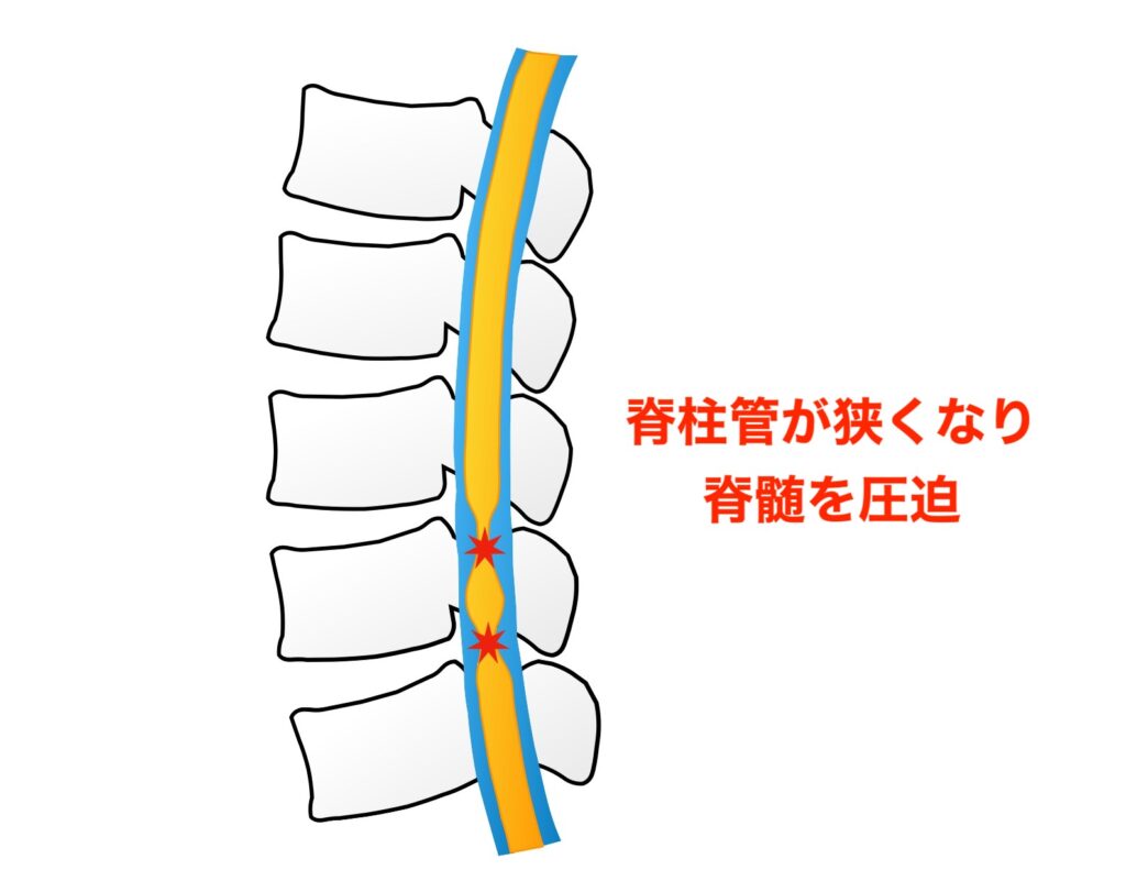 狭窄症画像