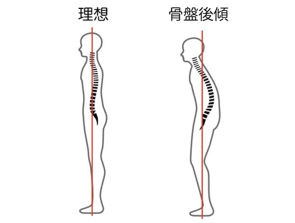 骨盤の正常と後傾の比較図