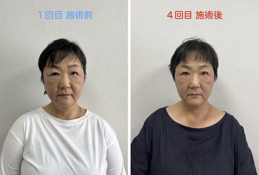 小顔モニタービフォーアフター