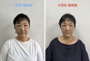 小顔モニタービフォーアフター