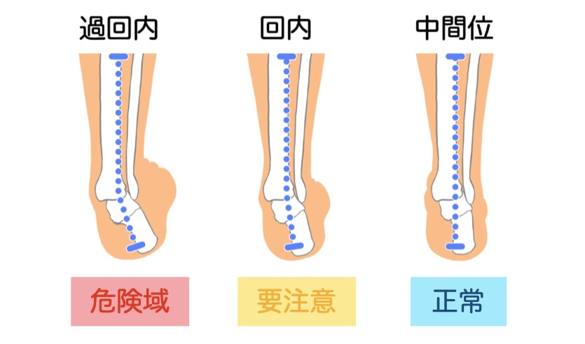 回内足重傷度合