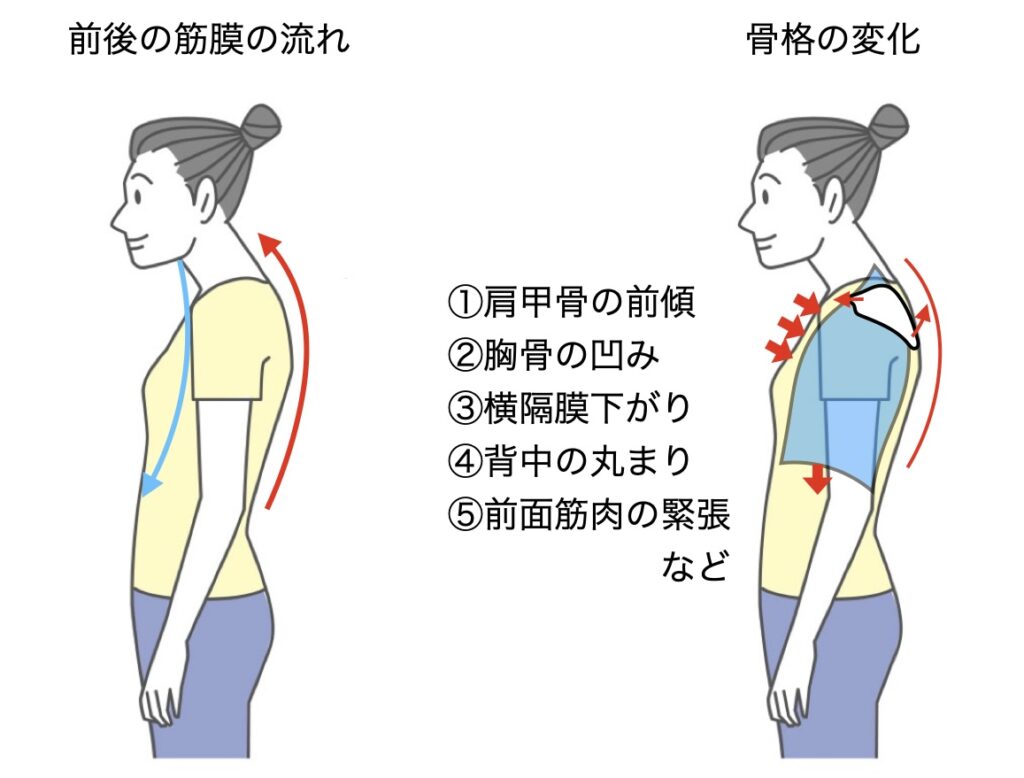 悪姿勢による組織変化