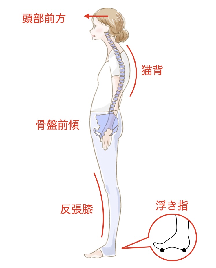 かかと重心で起きる問題
