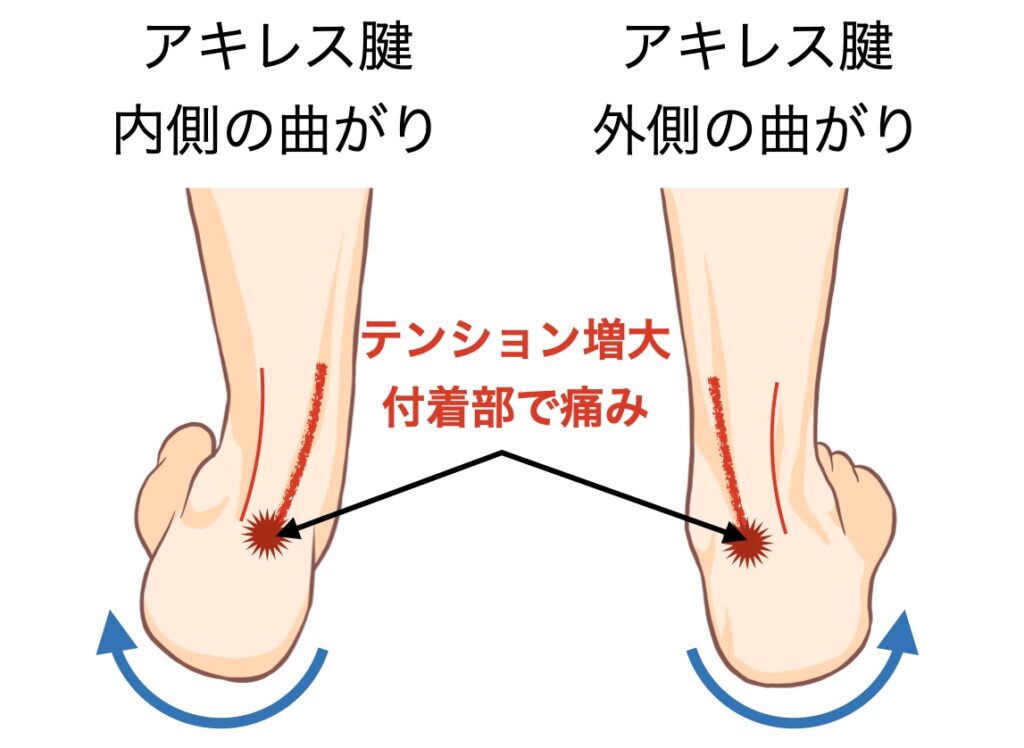 アキレス腱部の痛み